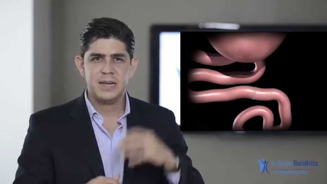 Cirugía de Bypass Gástrico por Laparoscopia