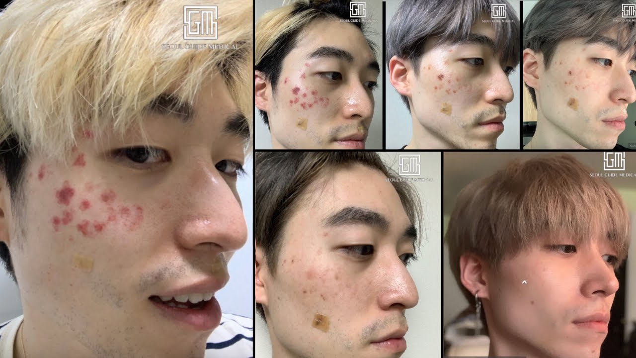 Mole Removal Before & After | Seoul Guide Medical