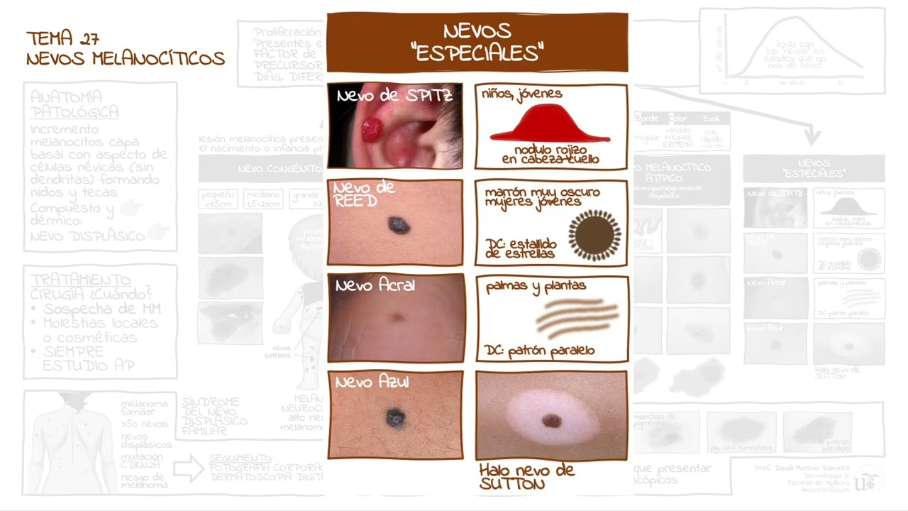Tema 27. Nevos Melanocíticos