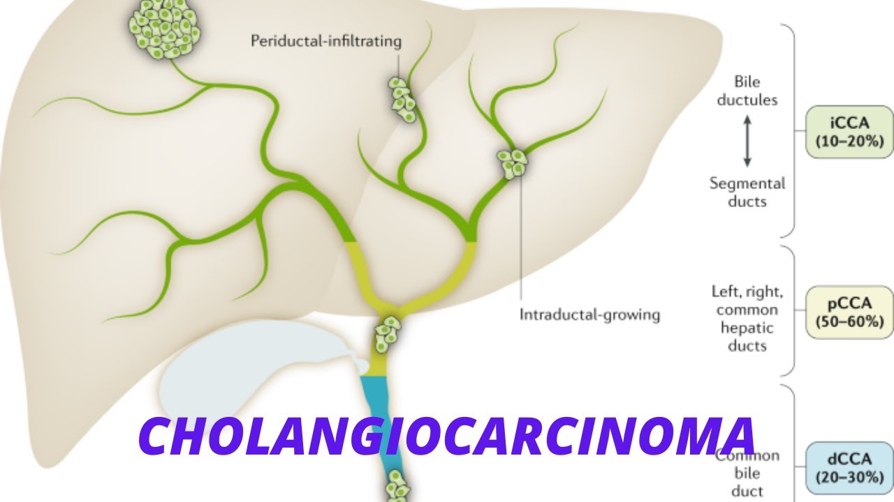 Cholangiocarcinoma