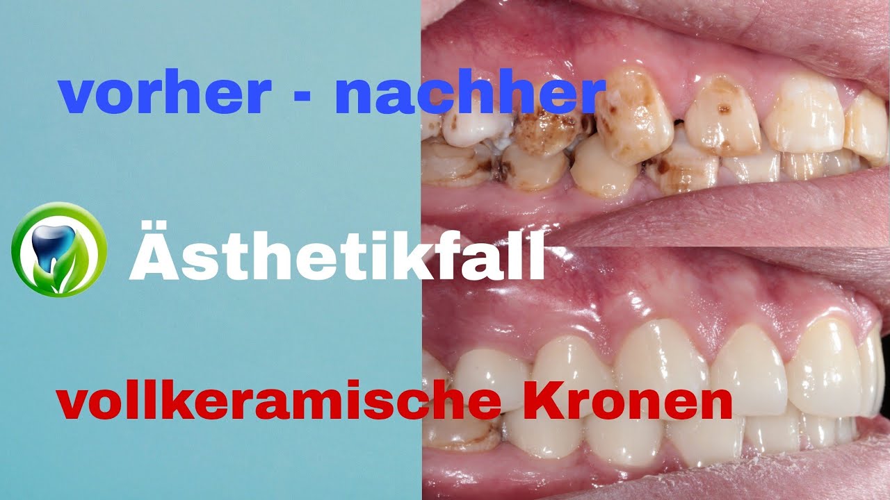 Vorher nachher Ästhetikfall mit vollkeramischen Kronen - Zirkon vollverblendet - metallfrei