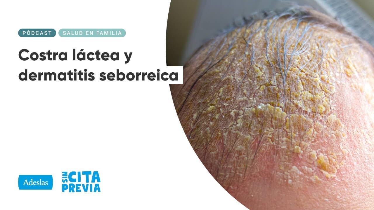 Costra láctea y dermatitis seborreica | Ep. 04x40