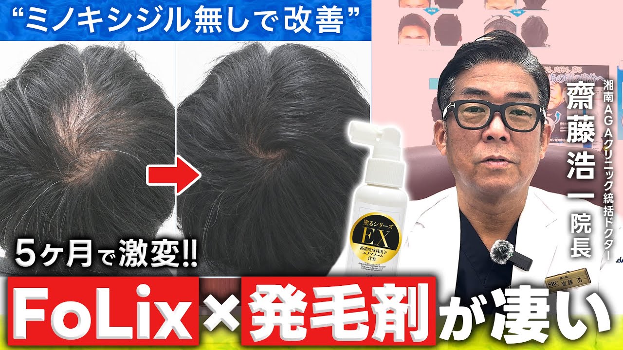AGA薬はフィナステリドのみ！？FoLix治療とオリジナル発毛剤で劇的改善！【ガイドライン重視】
