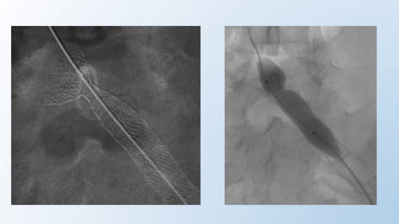 Consejos en el tratamiento endovascular del síndrome de May-Thurner