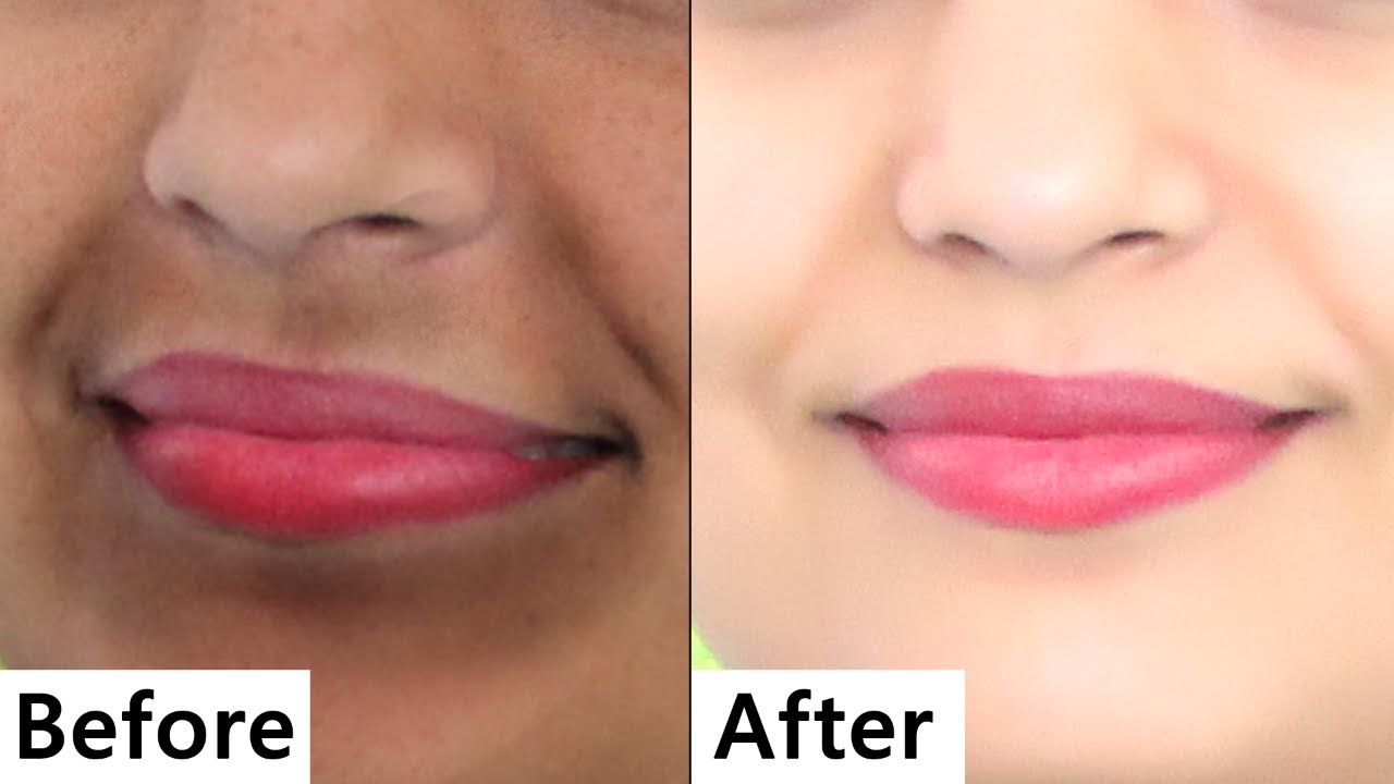 Remove Darkness around Lips | Dark Spots, Hyper Pigmentation, Around Mouth