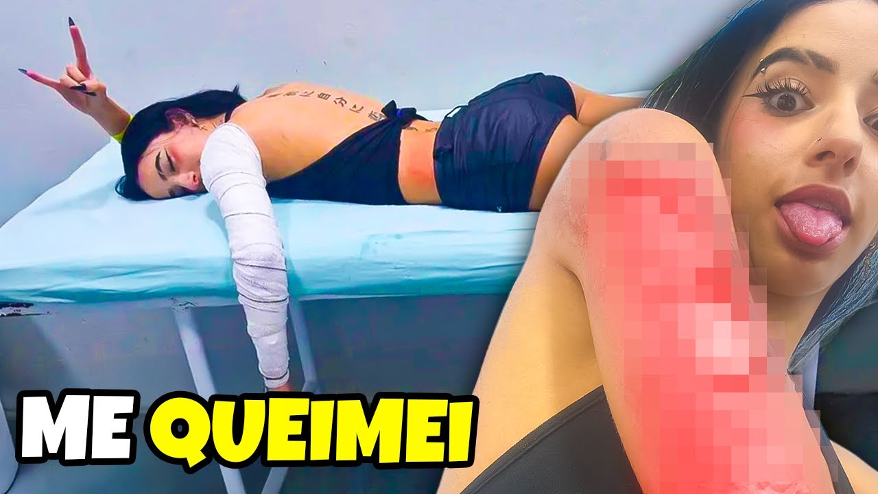como eu me queimei *literalmente*