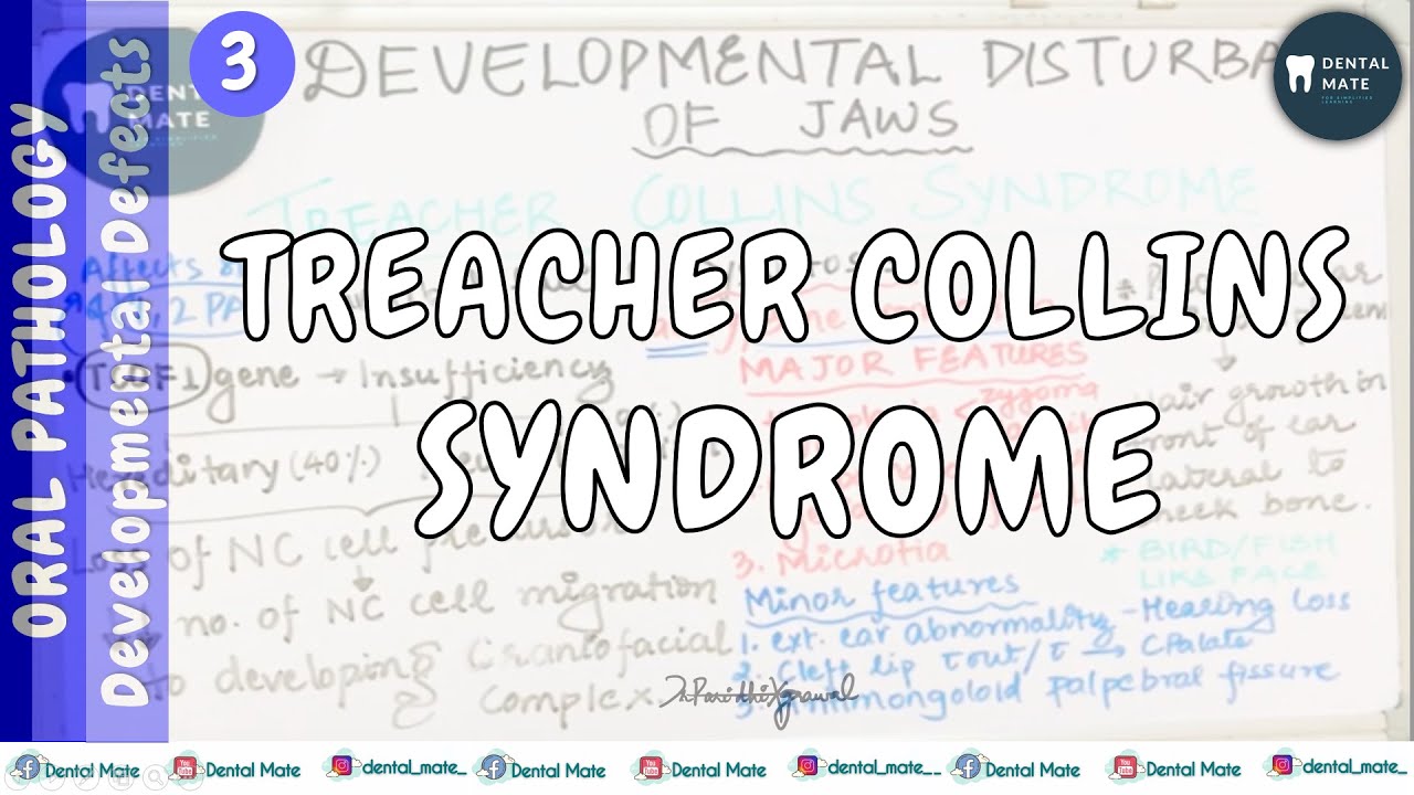 Treacher Collins Syndrome | Mandibulofacial Dysostosis | Dev. disturbances of jaw | Dr Paridhi