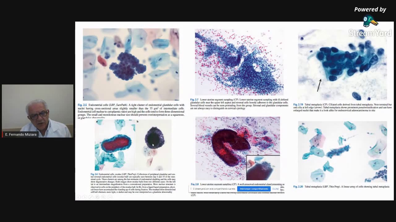 El Sistema Bethesda para Citologia cérvico vaginal