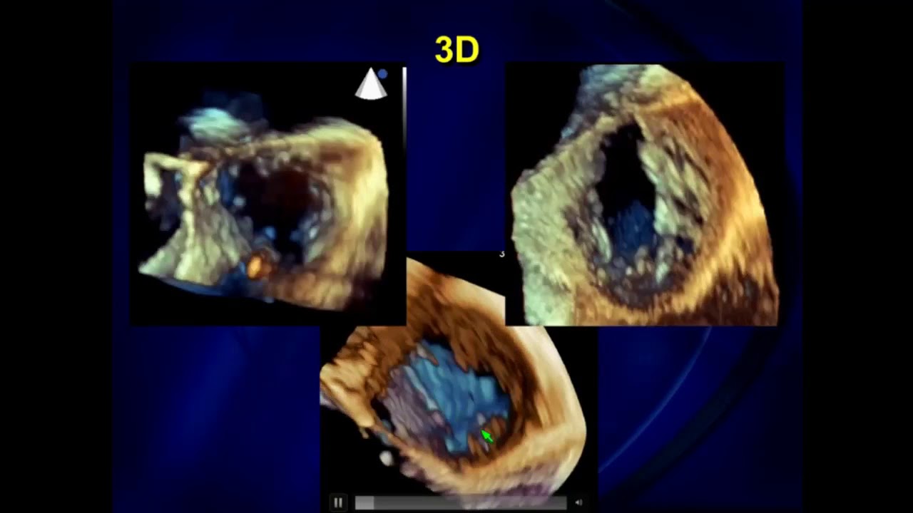 How Do I Image the Tricuspid Valve? - Richard Bae, MD