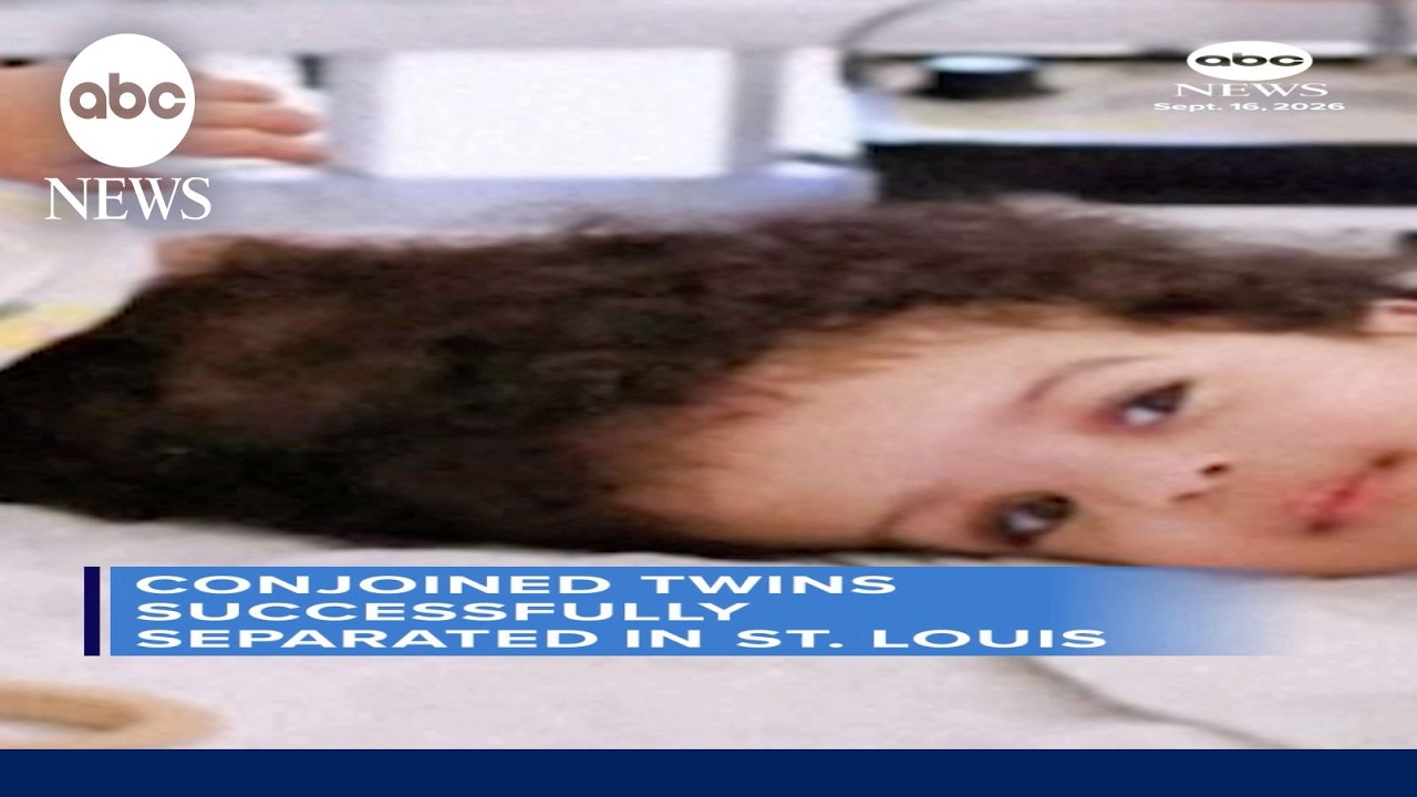 Conjoined twins successfully separated in St. Louis