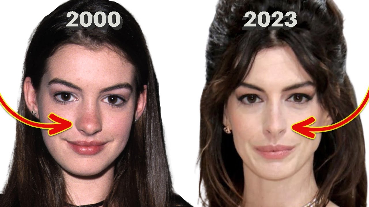 Anne Hathaway’s Before and After: Denies Nose Job (Lorry Hill)
