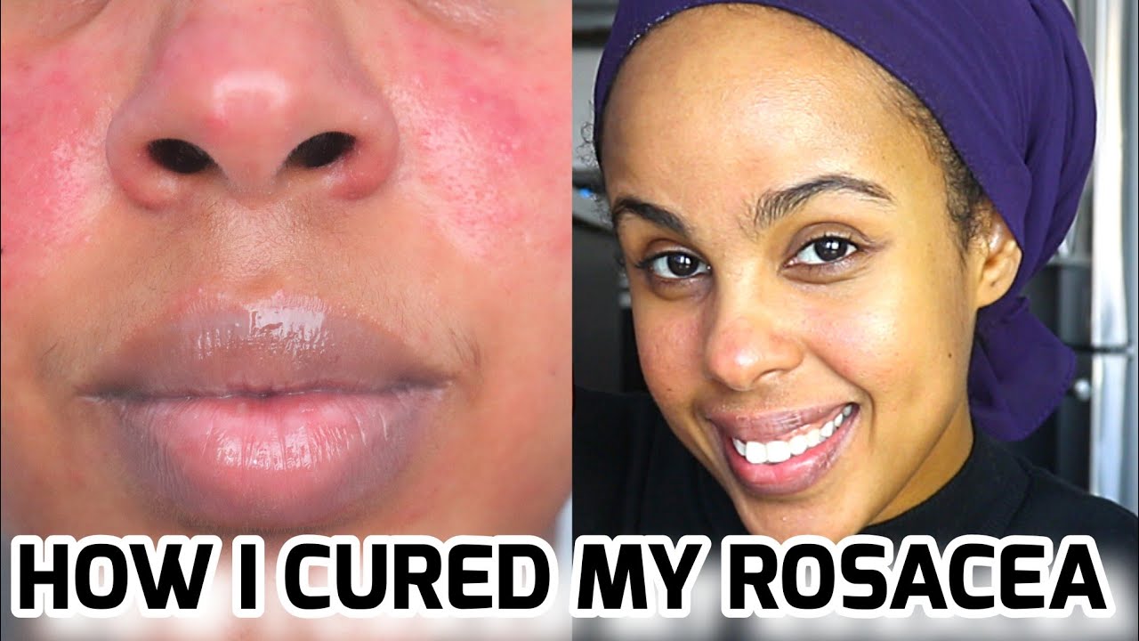 HOW TO GET RID OF ACNE | THE OIL CLEANSING METHOD | Natural skin care