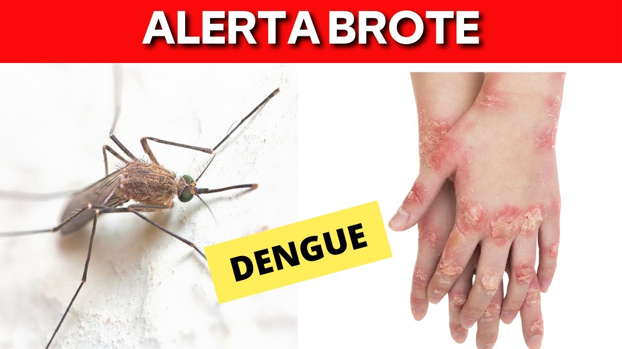 Los síntomas más peligrosos del Dengue