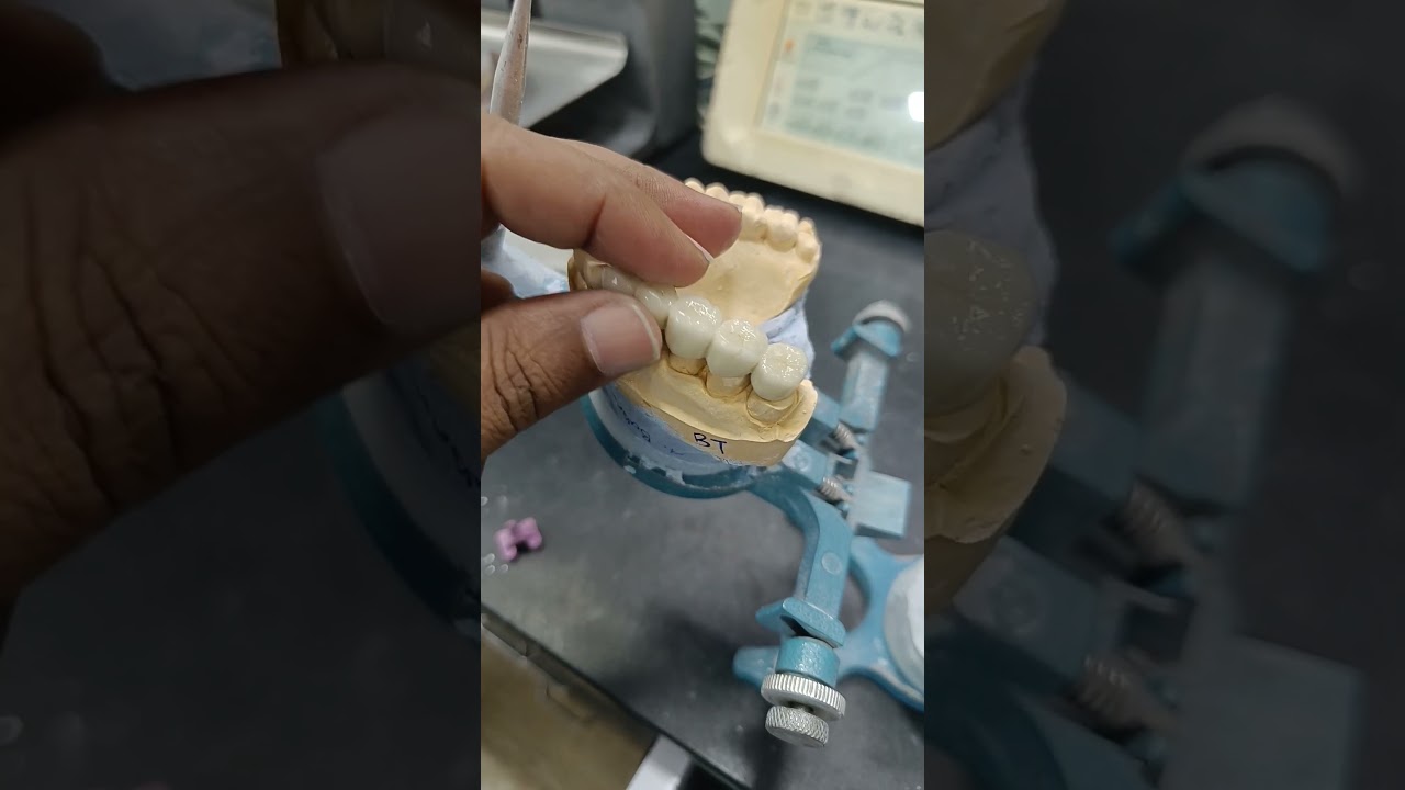 #dmls #pfm #cad  #dentalcenter #dentist #dentallaboratory  #dentalimplants  #dentcare