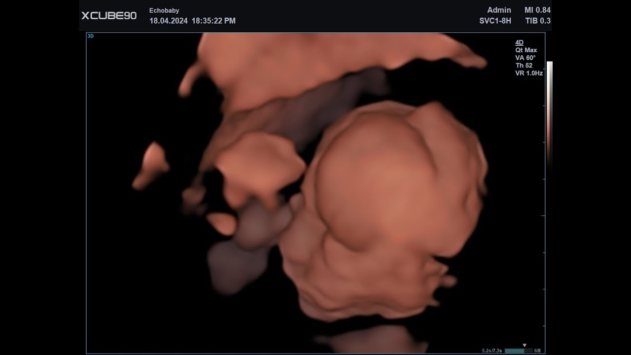 3D Echo 20 Weken Live Filmpje