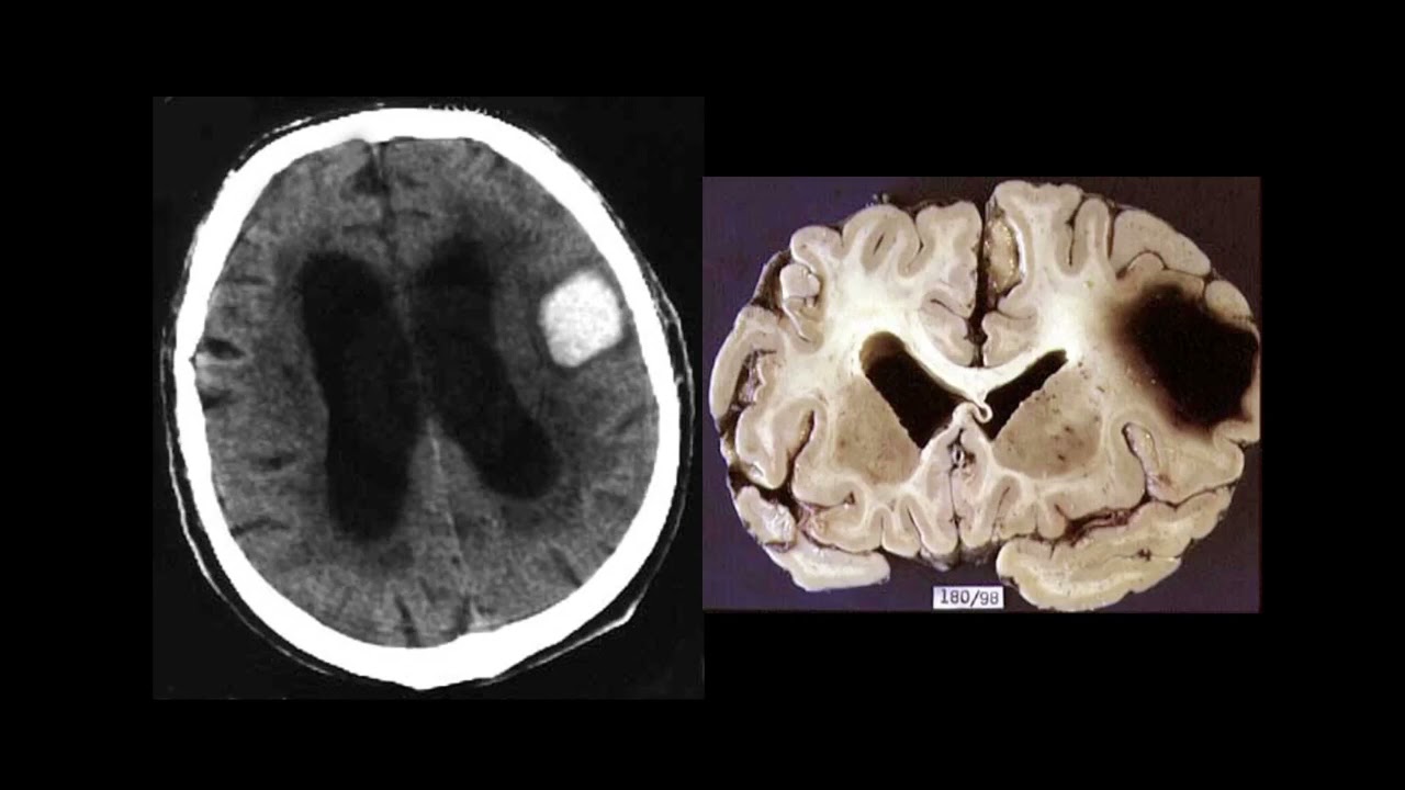 Imaging of intracranial hemorrhage
