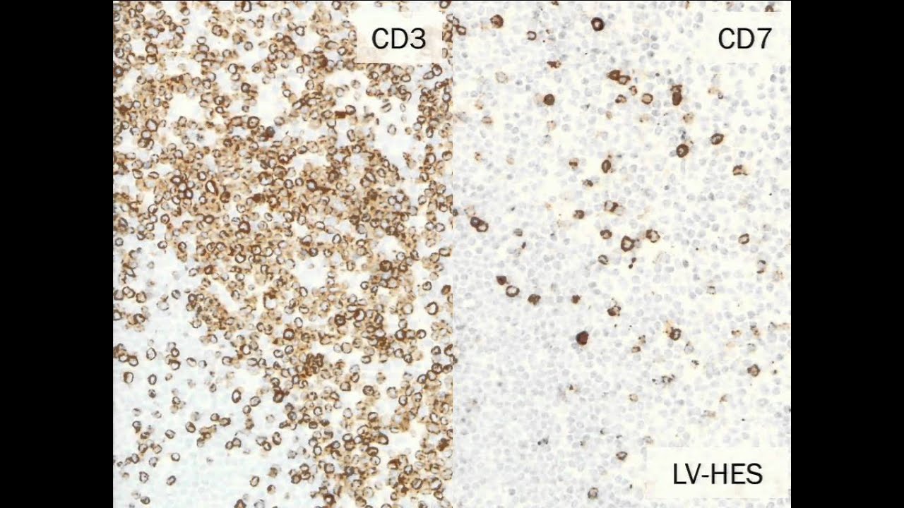 Diagnostic Algorithms for Eosinophilia and Mastocytosis
