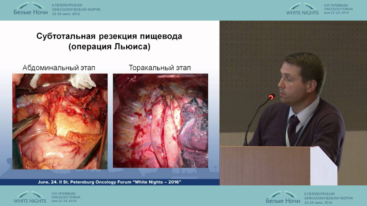 Comprehensive treatment of esophageal cancer with induction chemoradiotherapy
