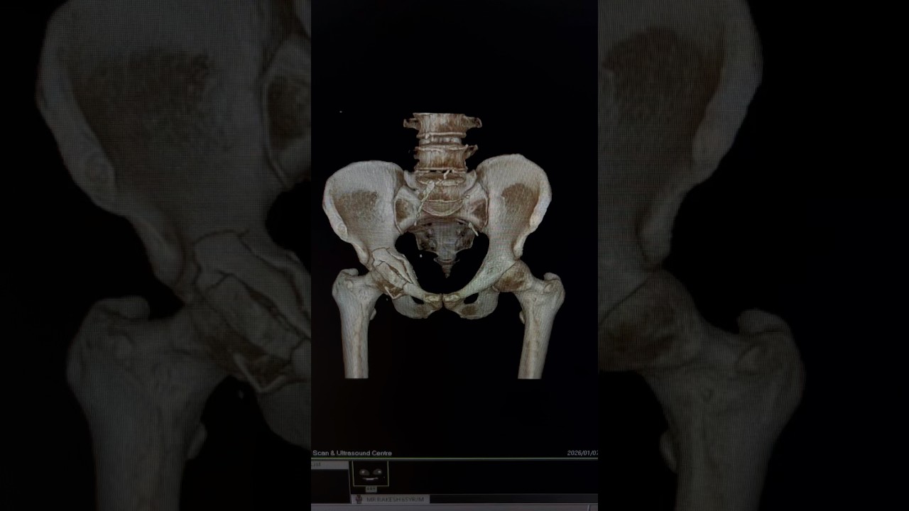 Pelvis Fracture in 3D | Acetabulum Injury 