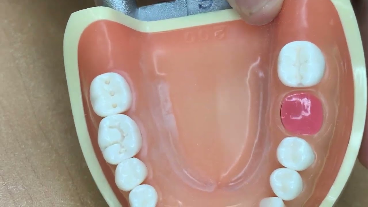 Cavidad Clase I simple