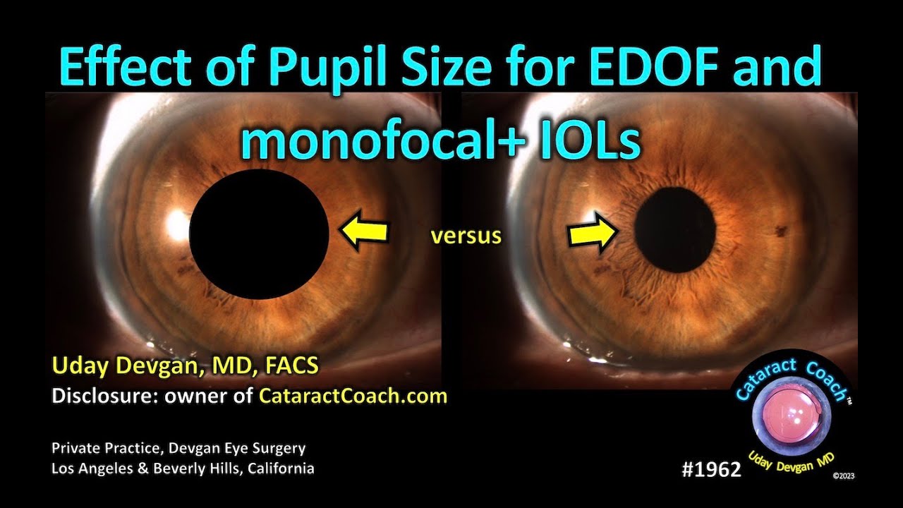 CataractCoach&trade; 1962: effect of pupil size for EDOF IOLs (extended depth of focus)