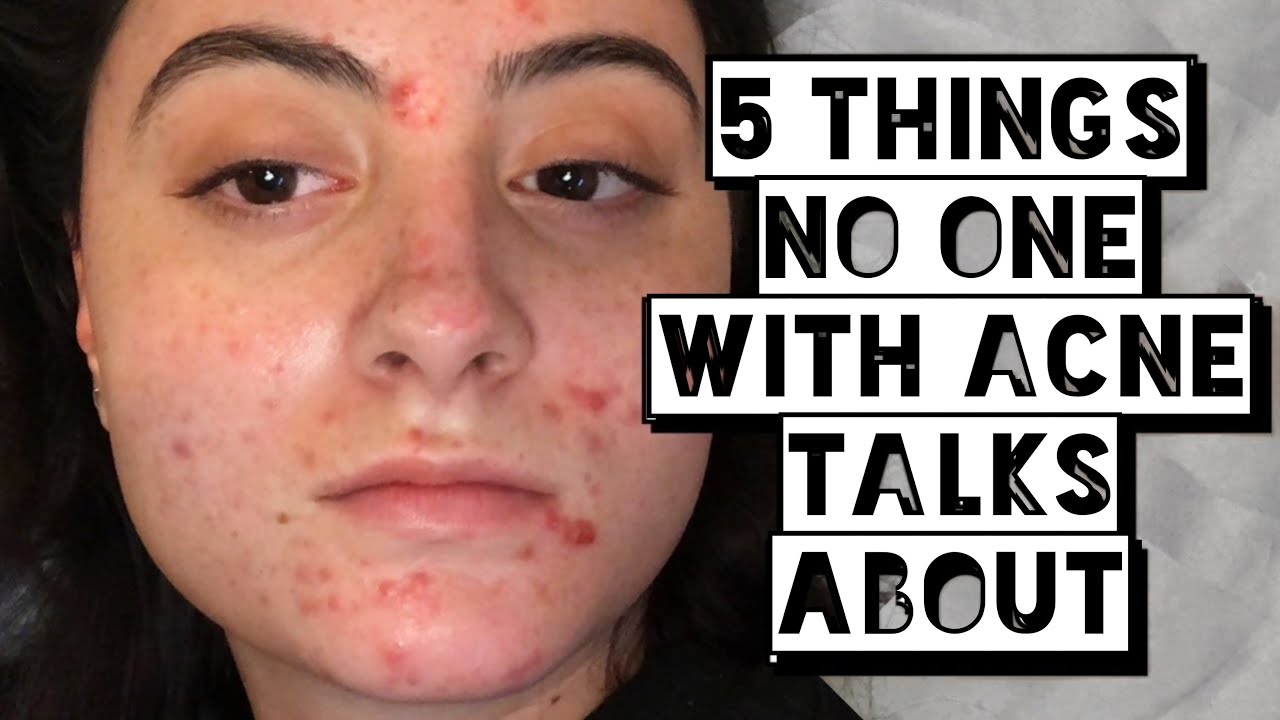 5 Things About Acne Nobody Talks About | If you have acne you need to know this...