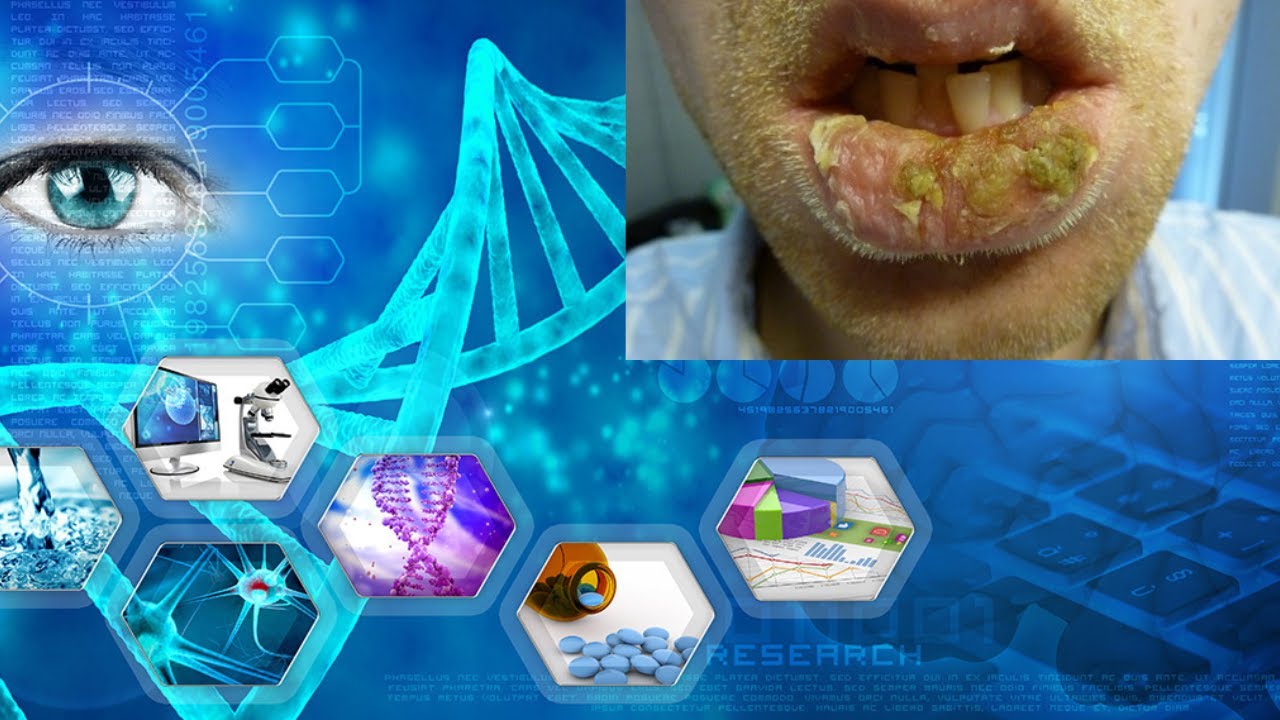 Unveiling the Pathophysiology of Exfoliative Cheilitis: Cellular and Molecular Insights