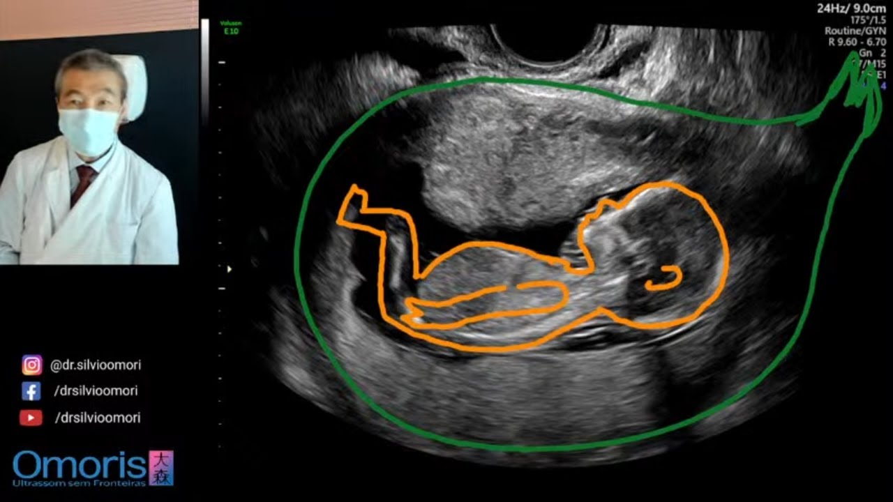 Qual o SEXO DO BEBÊ? Ultrassom 13 semanas de gravidez.