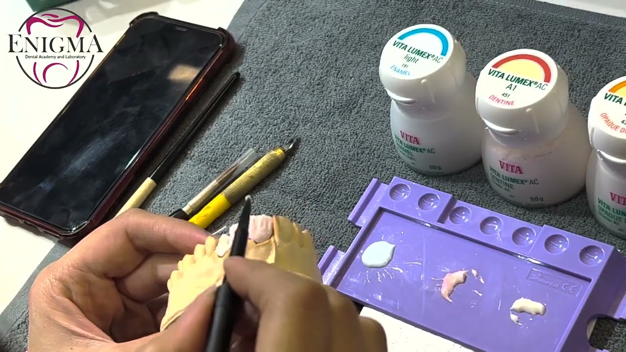 Ceramic build up for zircon anterior bridge
