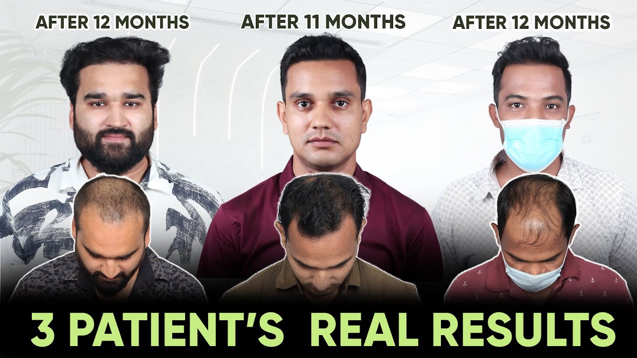 Hair Transplant in Hyderabad (HX-ZXCA) | Best Results & Cost of Hair Transplant in Hyderabad.