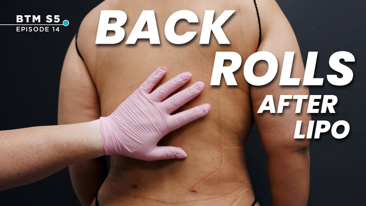 What Happens to Back Rolls After Liposuction?