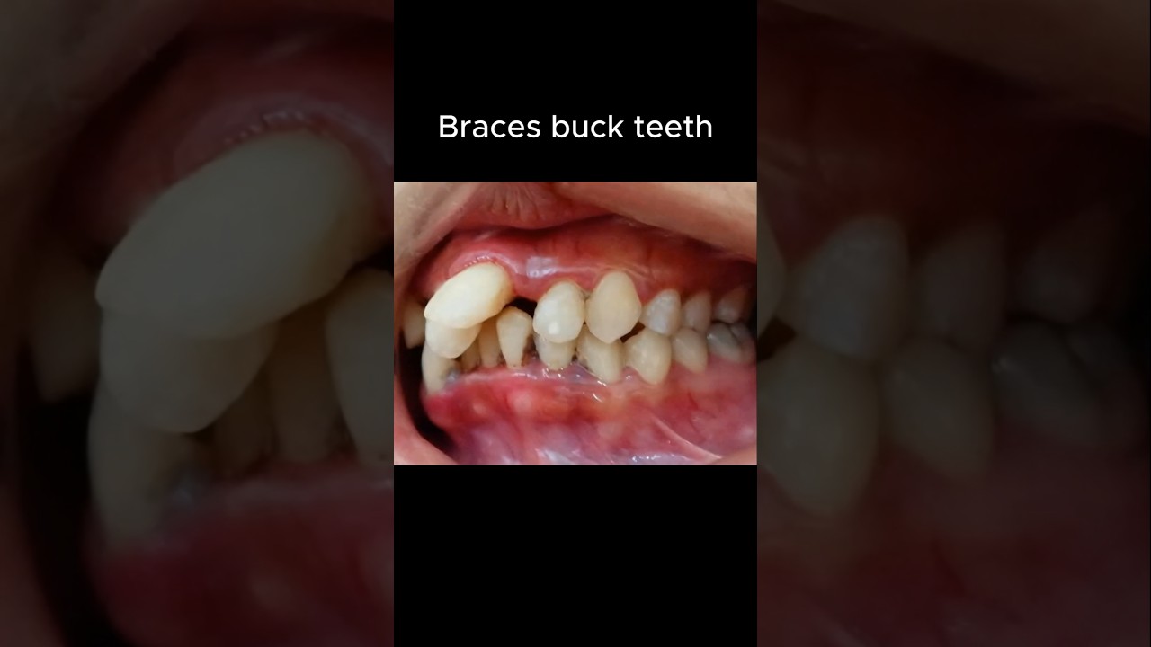 Braces for buck teeth #braces #orthodontist #dentist
