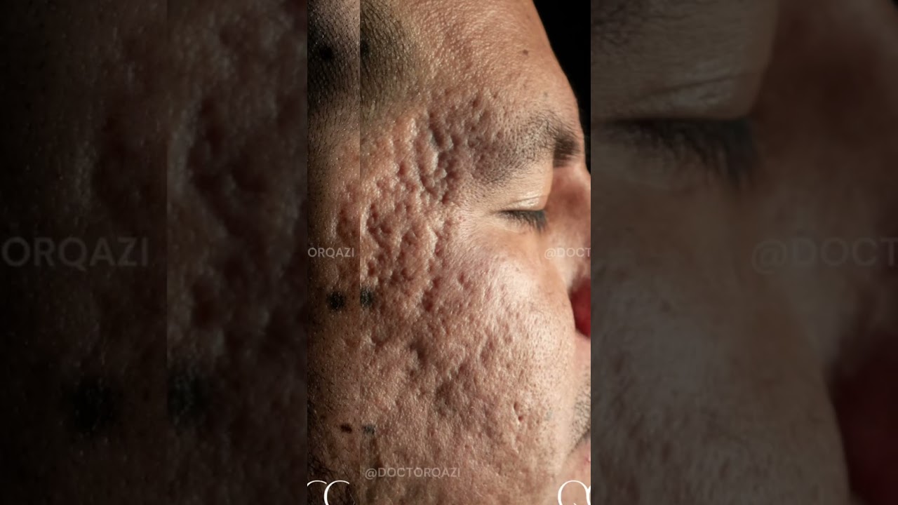 Severe Acne Scar Transformation #SkinRestoration