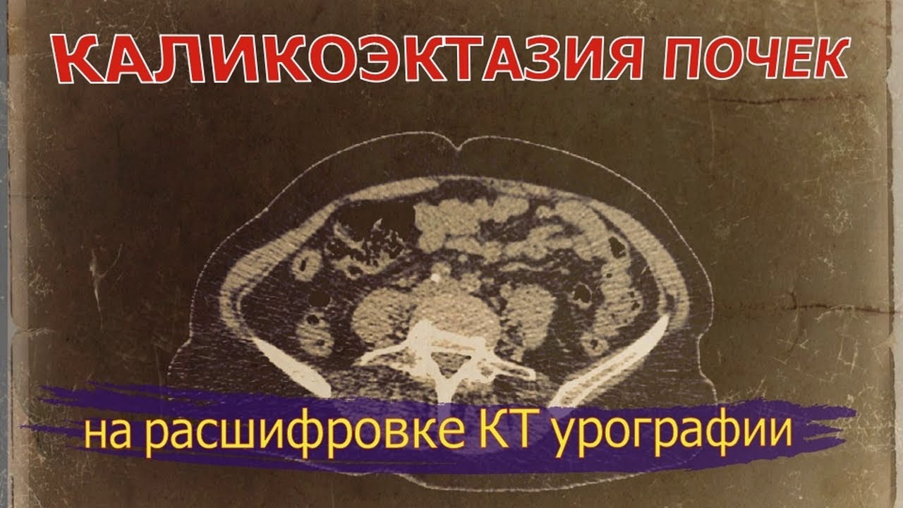 КАЛИКОЭКТАЗИЯ обеих почек и КИСТА правой почки на РАСШИФРОВКЕ КТ урографии (второе мнение)