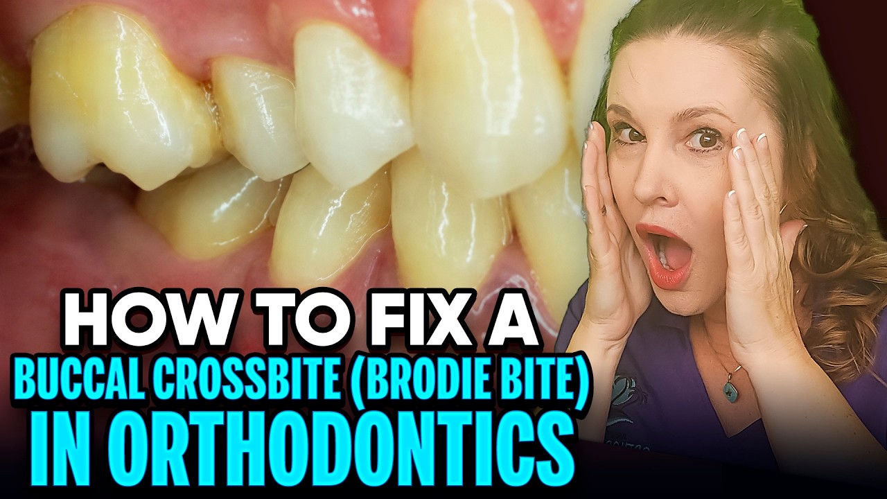 Buccal, Brody, Brodie, Scissor Crossbite and How to Fix