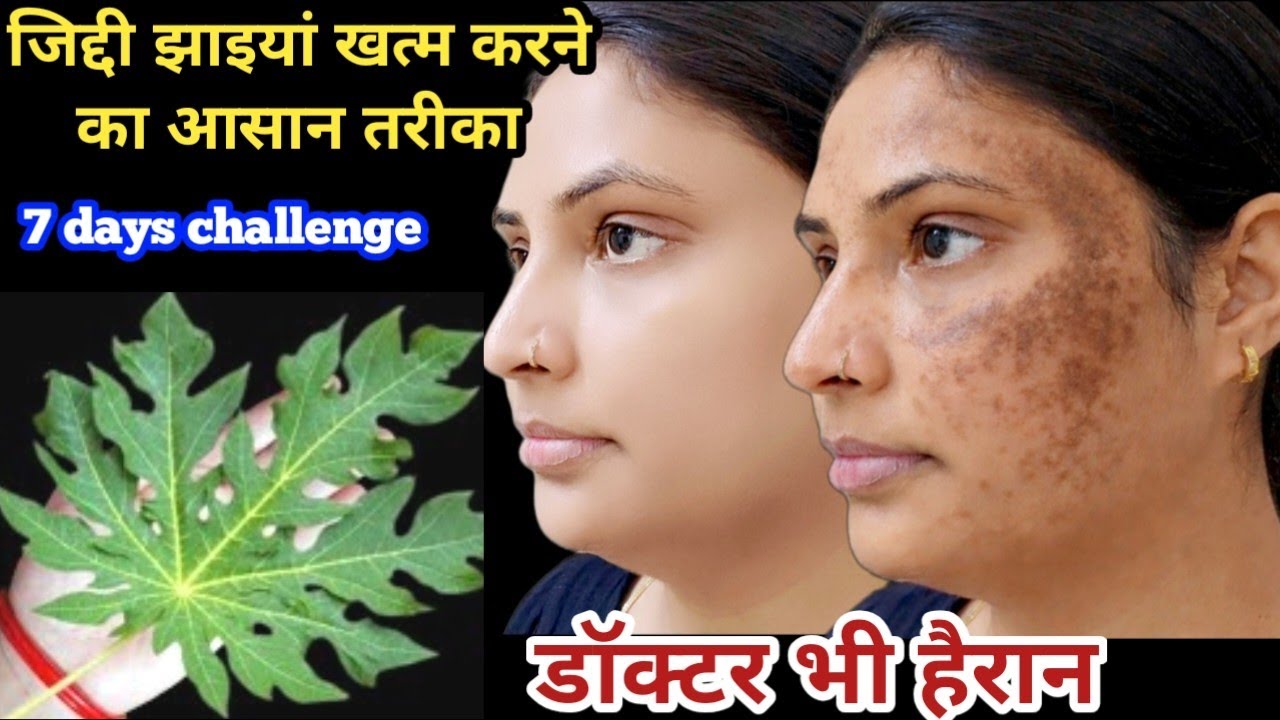 सिर्फ 7 दिनों में जिद्दी काली झाइयां जड़ से खत्म Reduc Melasma, Pigmentation,Discolouration