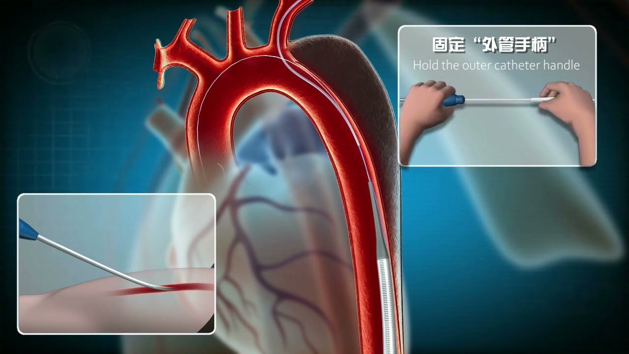 Castor - TEVAR Animation - Operational Video