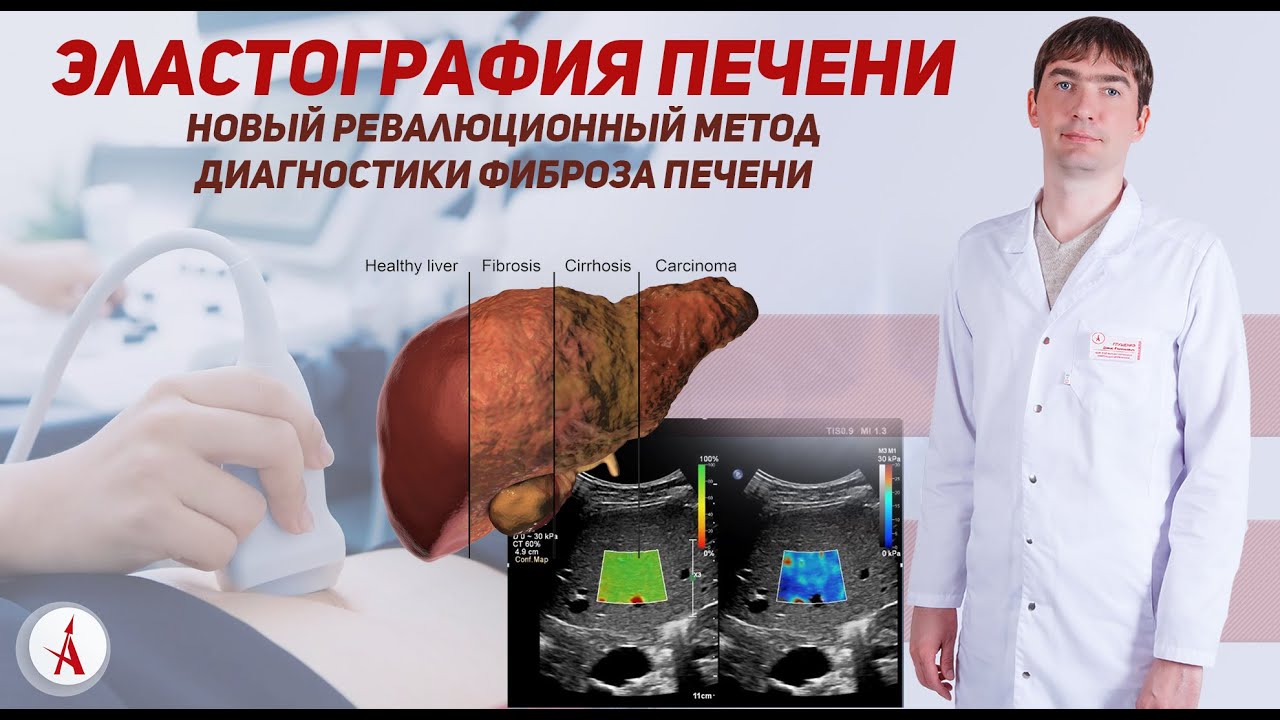 Эластография печени сдвиговой волной. Диагностика фиброза печени.