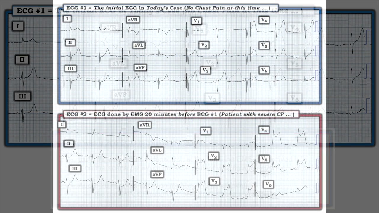ECG Blog #408 &mdash; A Difference of 20 Minutes ...a