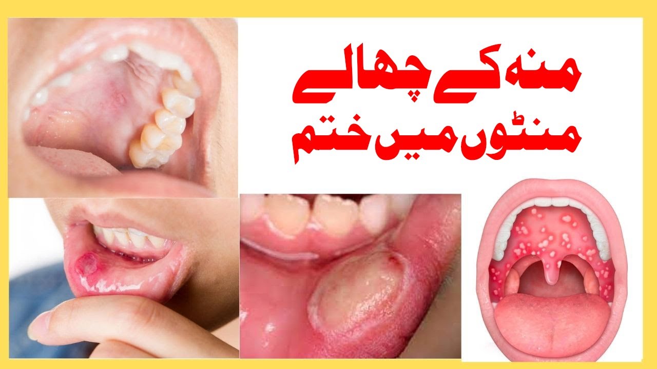 Muh K Chalon or Dano Ka Ilaj | Mouth Ulcer Blisters | منہ کے دانوں اور چھالوں کا علاج | Hakeem Waqas