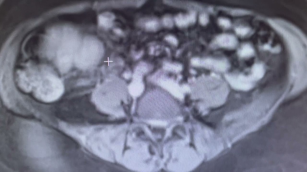 Abdominal MRI Analysis by Radiologist, Dr. Richard Semelka
