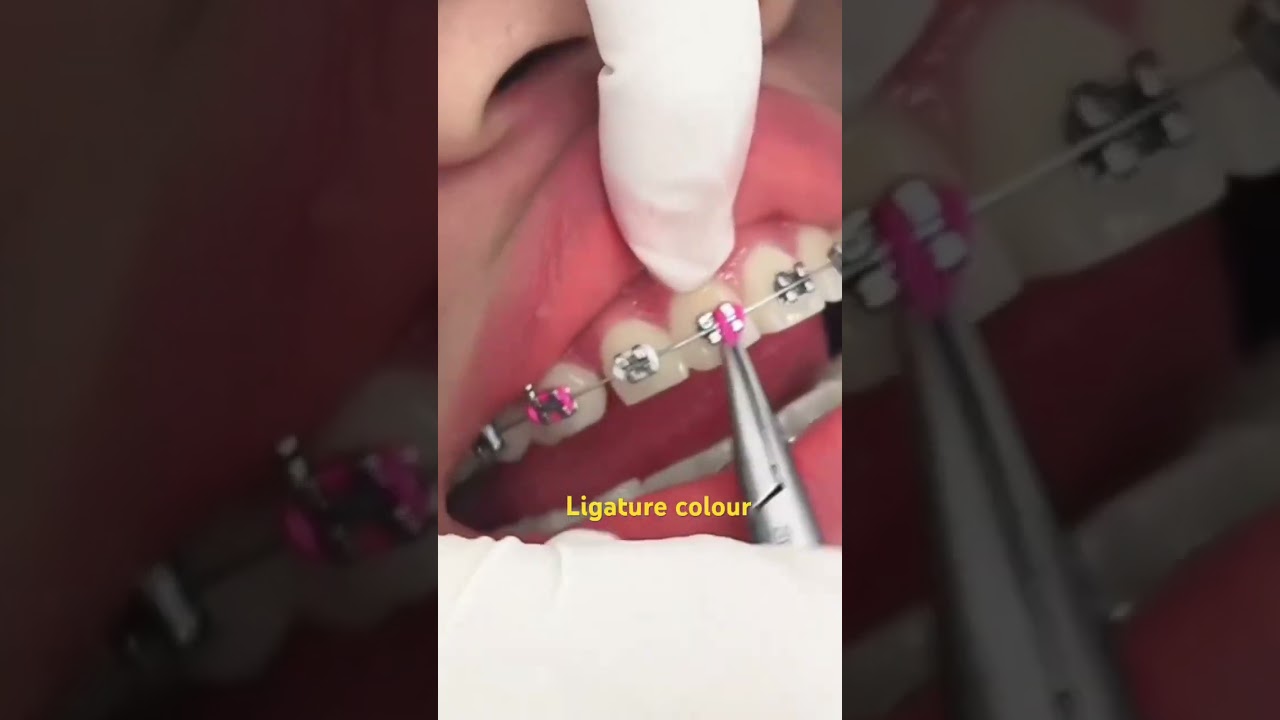 Ligature with a new colur|Orthodontic Dentistry🦷😍