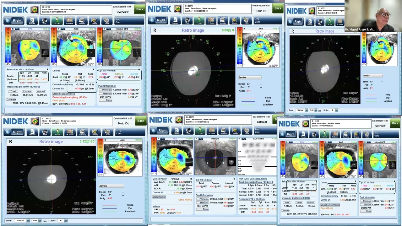 MS39, OPD, Sirius + o Pentacam; ¿Cuando usar que?