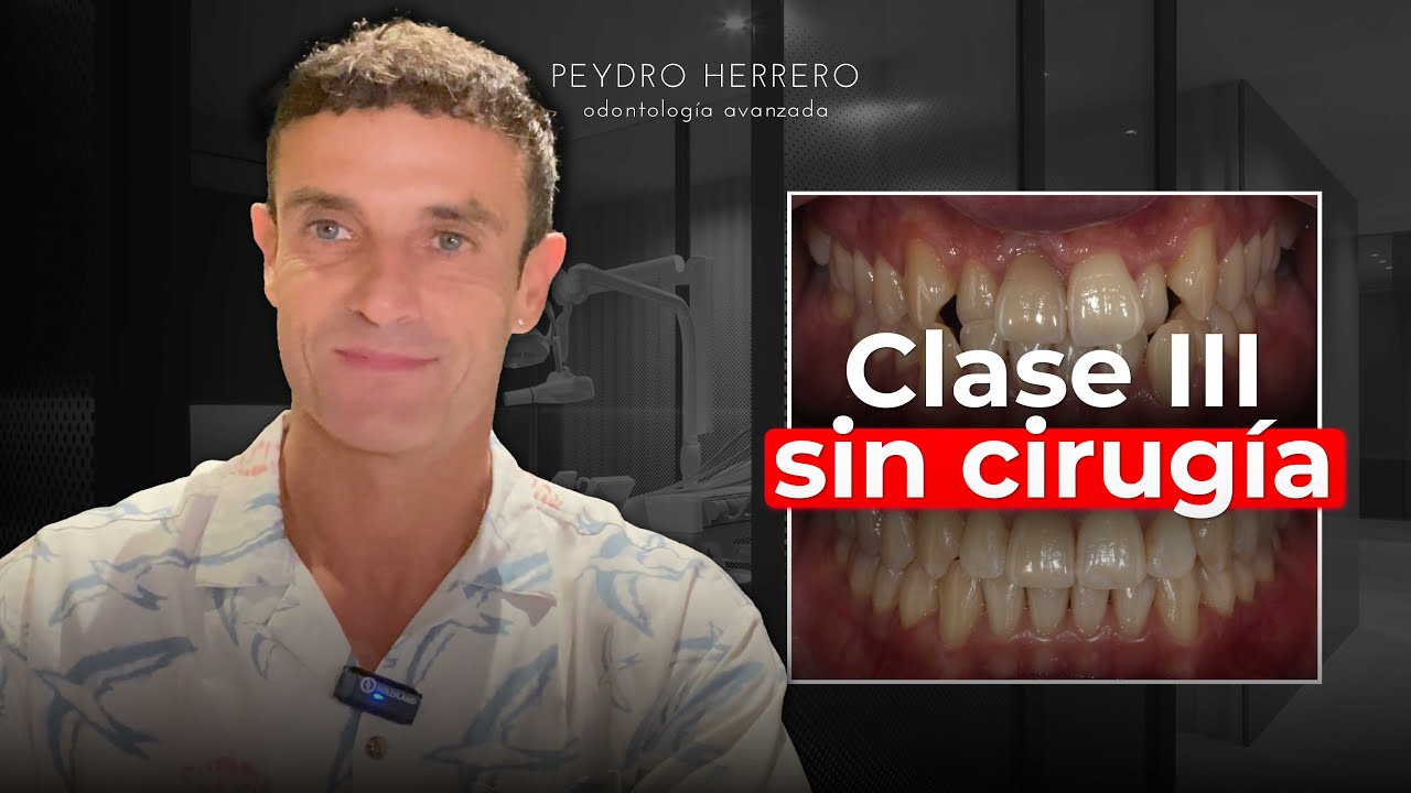 Clase III: cómo corregir una maloclusión severa SIN cirugía ni extracciones | Ortodoncia invisible