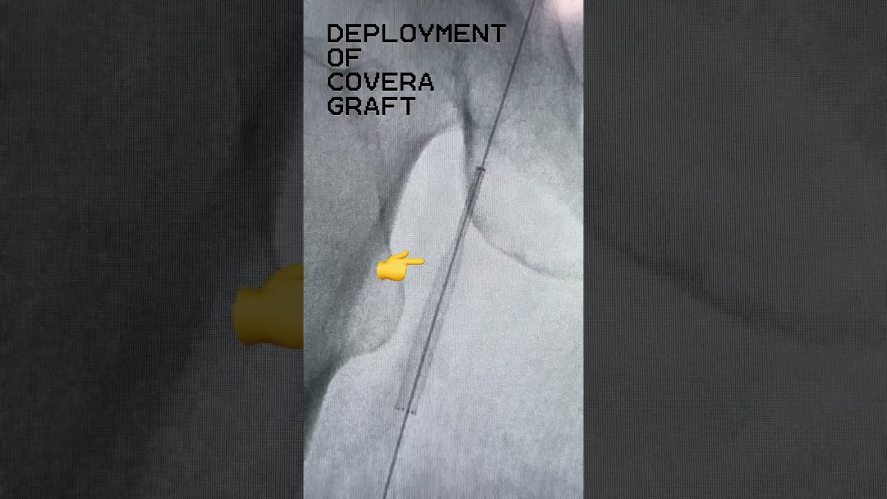 Treatment of femoral AV fistula #interventionalradiology #angioplasty