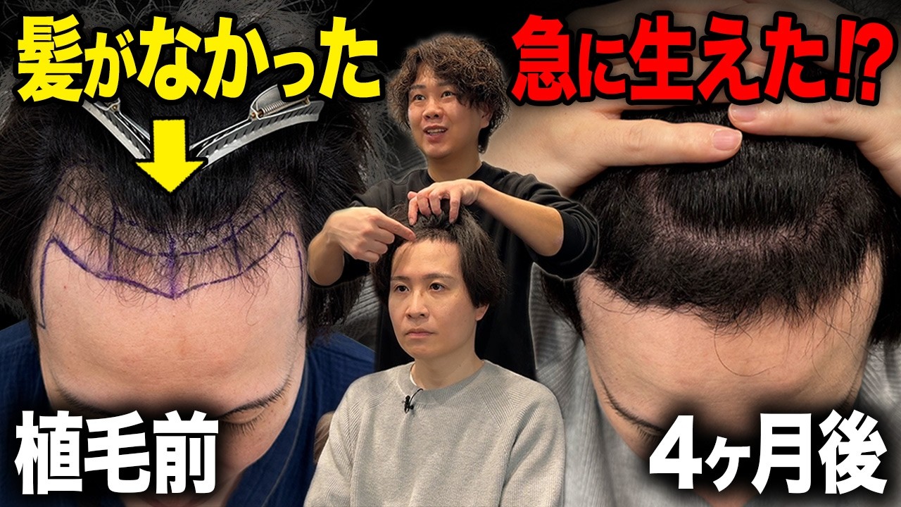 【予想外】不安すぎた日々が一変…植毛4ヶ月で急に密度が埋まってきた!!
