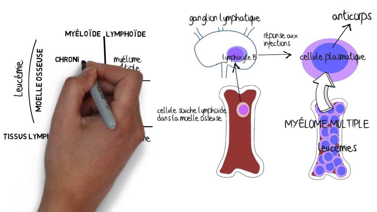 Comprendre le myélome multiple