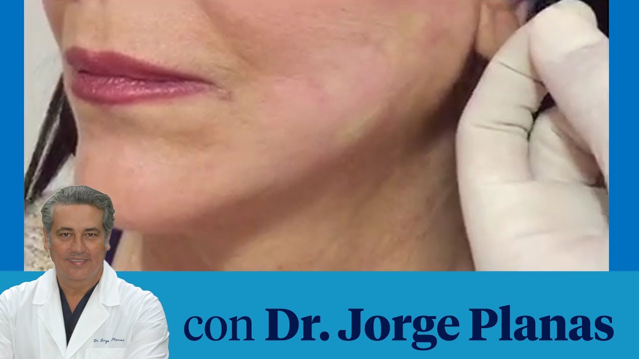 ¿Qué son los hilos tensores?