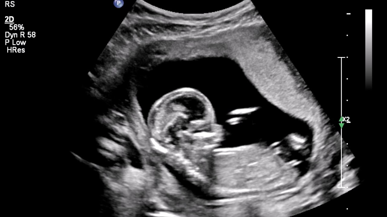 2D Echo Geslacht 13 Weken Meisjes