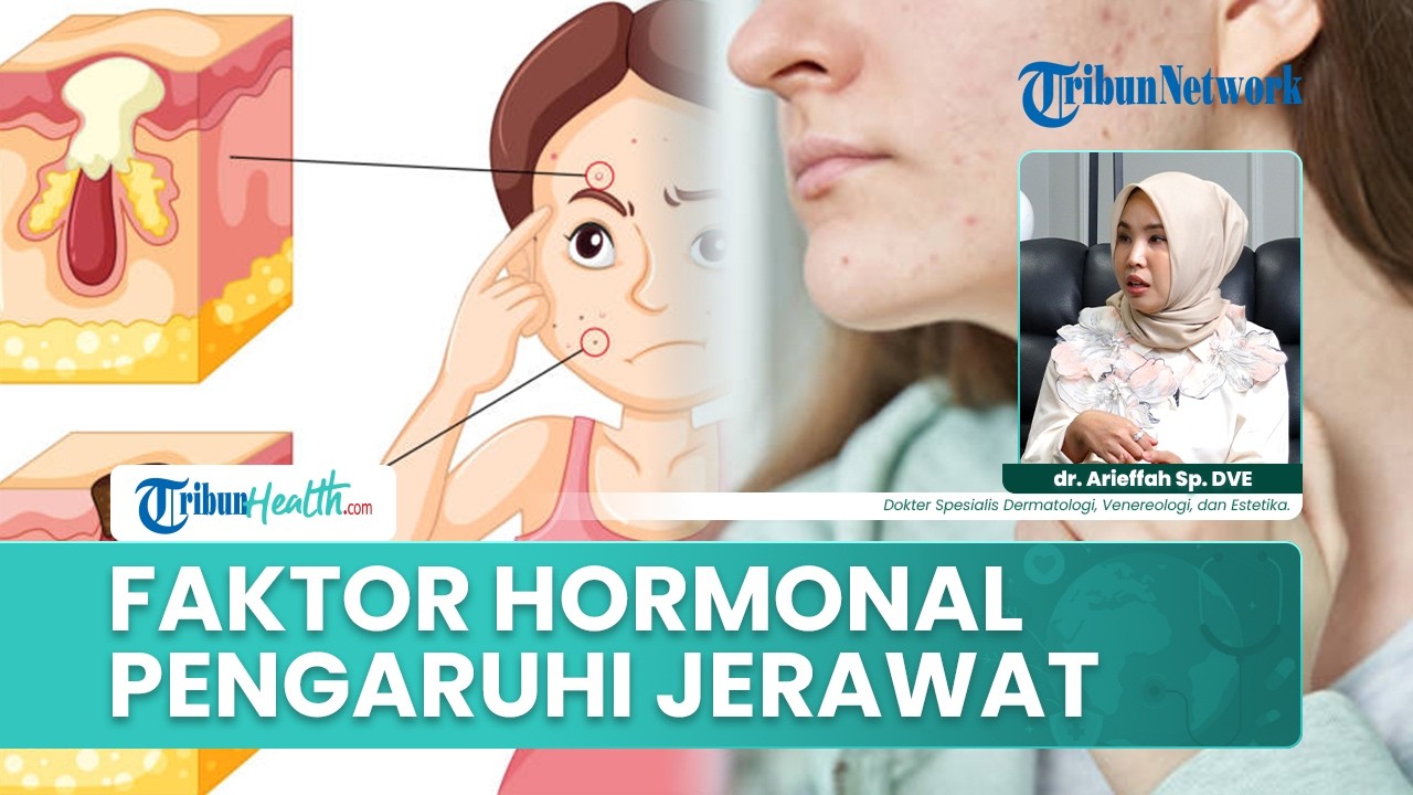 Di Usia Dewasa Jerawat Kambuh dan Memburuk, Dokter : Faktor Hormon dan Gaya Hidup Mempengaruhi